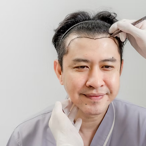 MSAT Hair Transplant