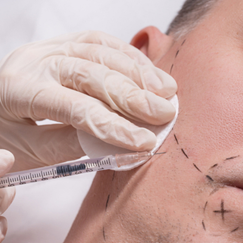 Beard & Mustache Transplant