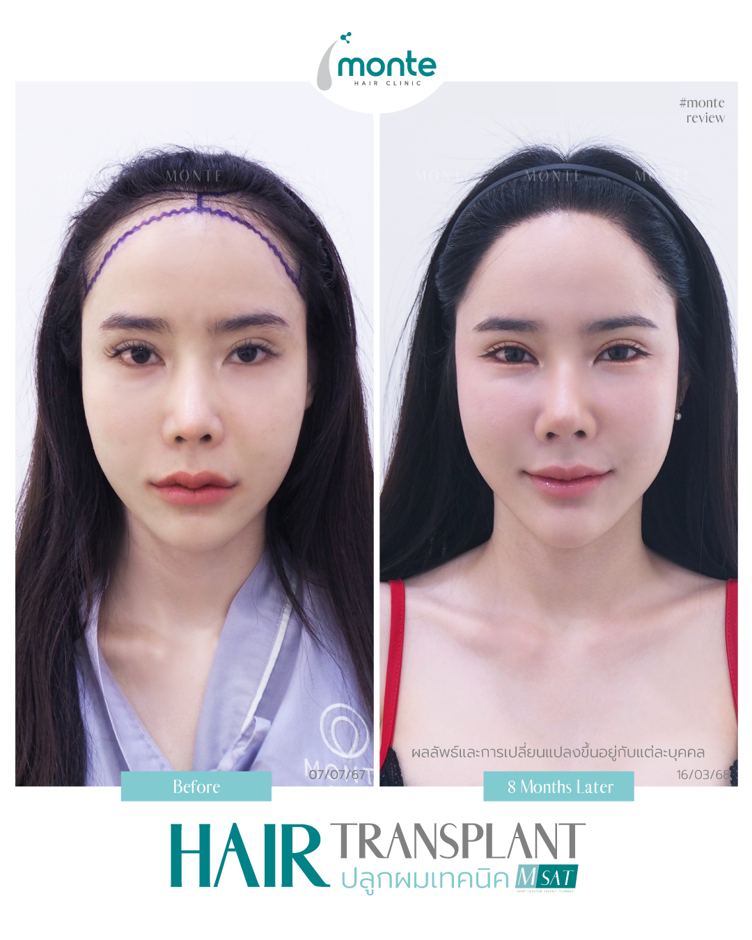 Testimonial 6 – MSAT ไข่มุก